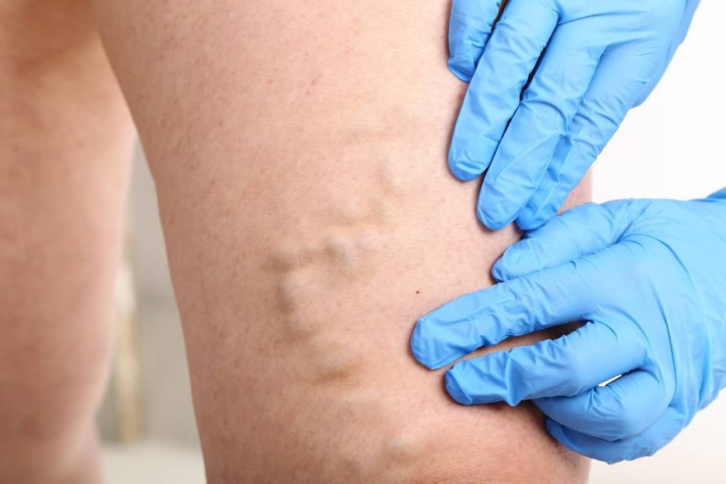 Spider Vein Treatment Patient Transformation and Recovery